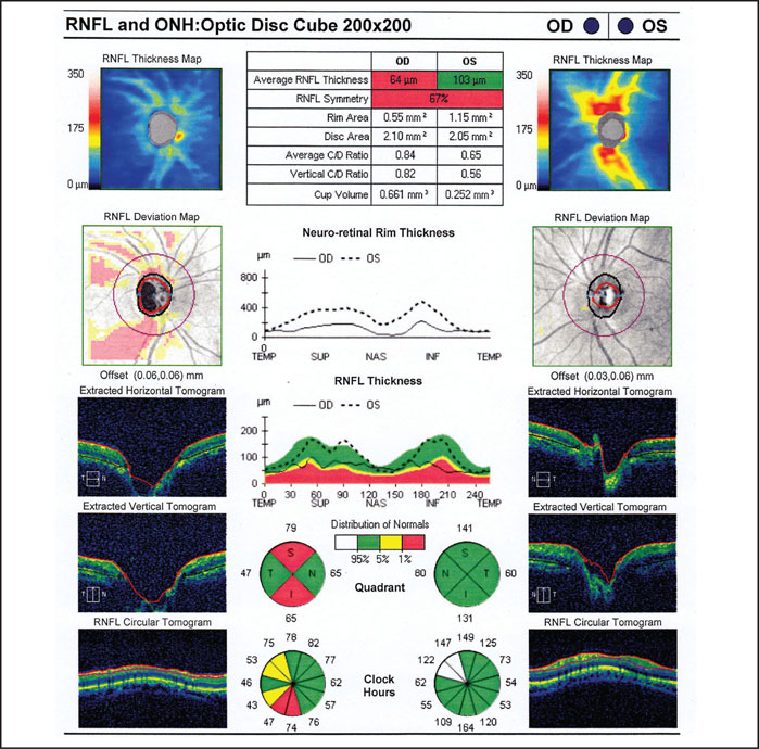 Glaucoma-Optometrist-Calgary