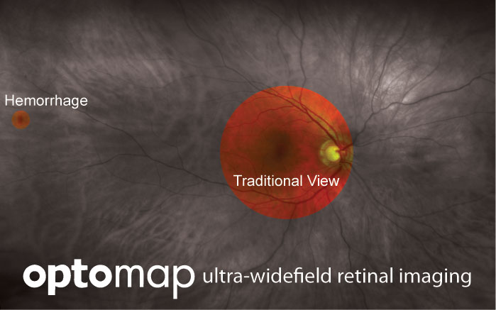 Optomap-Calgary-Optometrist